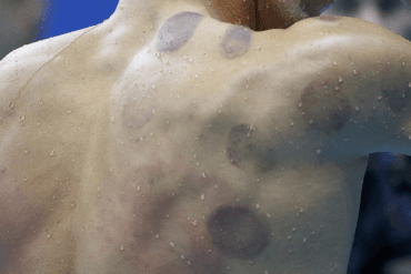 Ozonoterapia: Nuevos beneficios